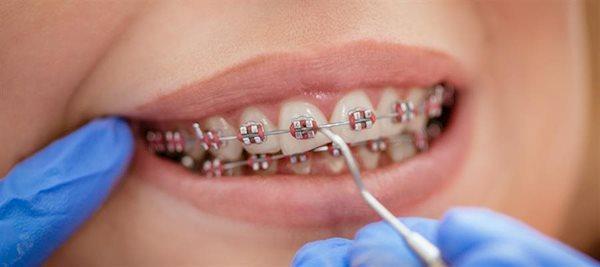 چگونه از دندان ها حین درمان ارتودنسی مراقبت کنیم؟