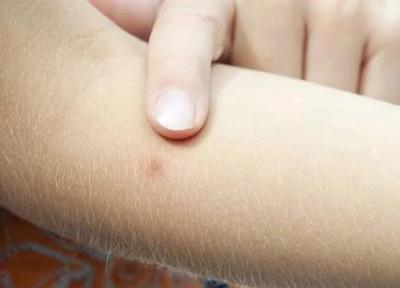 چرا جای نیش پشه می خارد؟